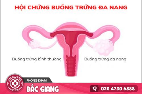 Nguyên nhân gây buồng trứng đa năng là gì? Cách trị hiệu quả?