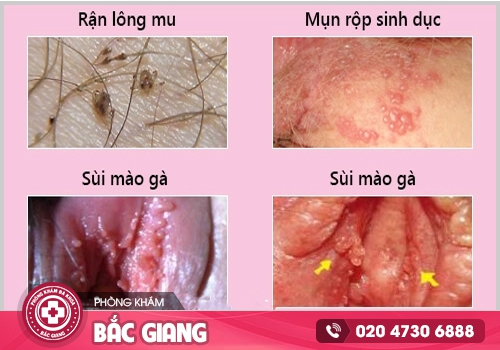 Cách làm giảm ngứa vùng kín được các bác sĩ chuyên khoa chia sẻ
