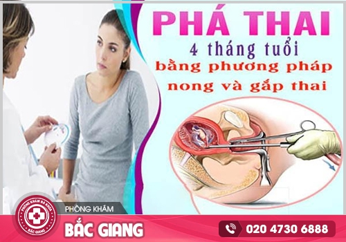 Chi phí phá thai 4 tháng phụ thuộc vào những yếu tố nào?