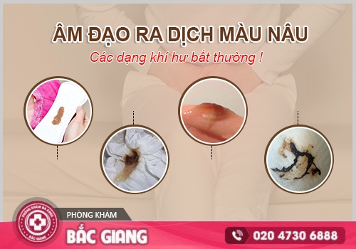 Vùng kín ra dịch nâu là bệnh gì? Khi nào cần đi khám bác sĩ?