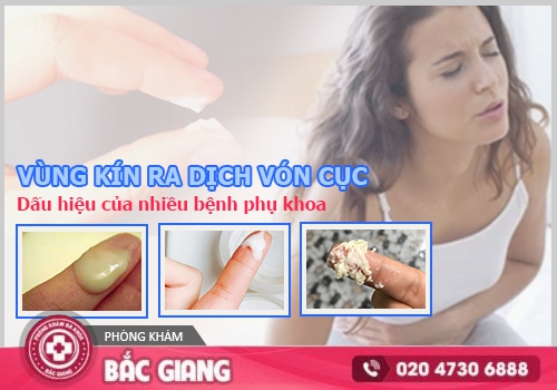 khí hư vón cục