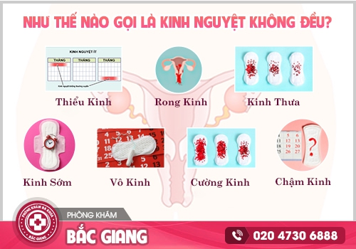 Kinh nguyệt không đều Nỗi ám ảnh của phụ nữ và những điều cần biết
