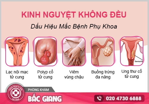 Kinh nguyệt không đều Nỗi ám ảnh của phụ nữ và những điều cần biết