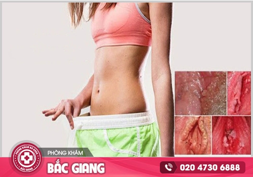 Lở loét âm đạo là dấu hiệu của bệnh gì?