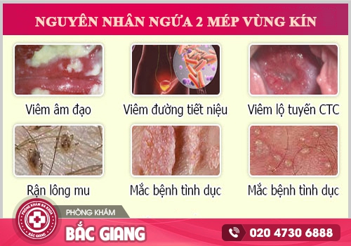 Có cách trị ngứa mép vùng kín tại nhà không?
