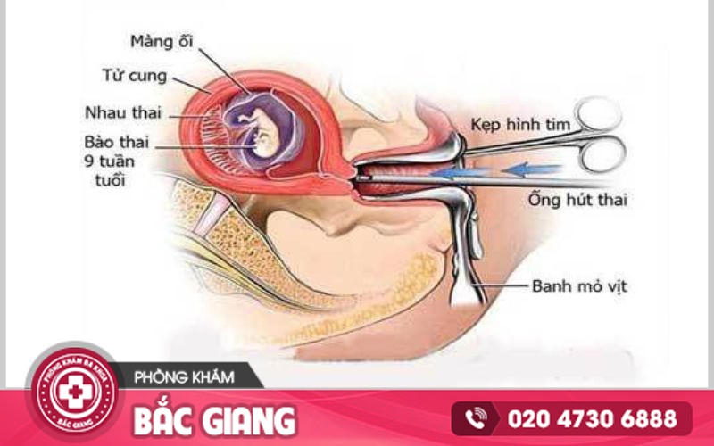 hút thai 7 tuần