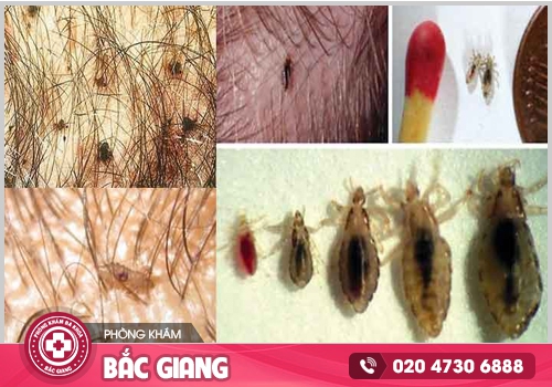 Rận mu vùng kín - Những điều có thể bạn chưa biết?