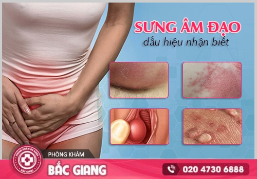 Sưng âm đạo là bệnh gì? Có nguy hiểm không?