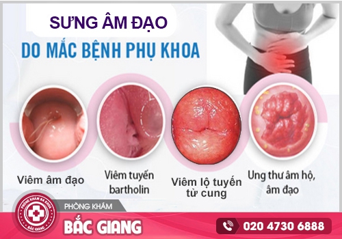 Chữa sưng vùng kín tại nhà như thế nào hiệu quả?