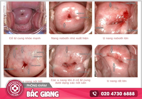 Giải đáp từ chuyên gia về cách trị nang Naboth tại nhà