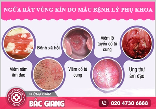 Ngứa rát vùng kín là biểu hiện bệnh gì? Cách điều trị tại nhà