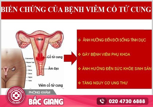 Tìm hiểu về viêm cổ tử cung trước khi bệnh ảnh hưởng tới sức khoẻ