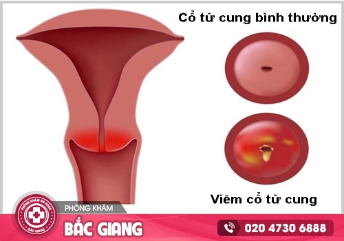 Tìm hiểu về viêm cổ tử cung trước khi bệnh ảnh hưởng tới sức khoẻ
