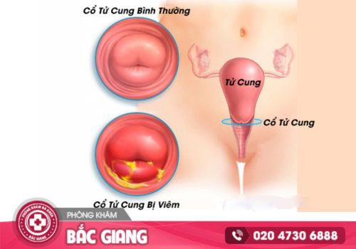 viêm cổ tử cung