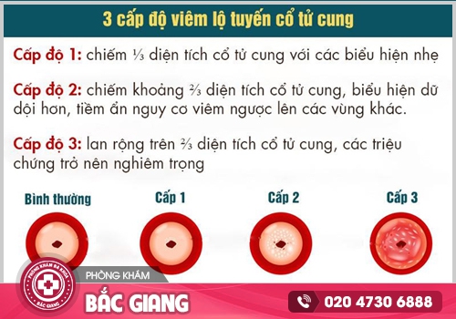 Viêm nội tuyến cổ tử cung là gì? Cách chữa trị ra sao?