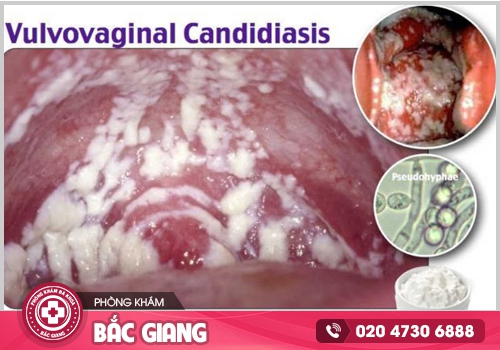 Hình ảnh ngứa vùng kín nữ - Kiểm tra xem bạn có đang mắc phải bệnh phụ khoa?