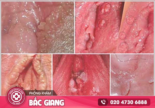 Hình ảnh ngứa vùng kín nữ - Kiểm tra xem bạn có đang mắc phải bệnh phụ khoa?