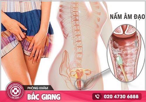 Viêm nấm âm đạo: Nguyên nhân, Dấu hiệu và Cách trị bệnh
