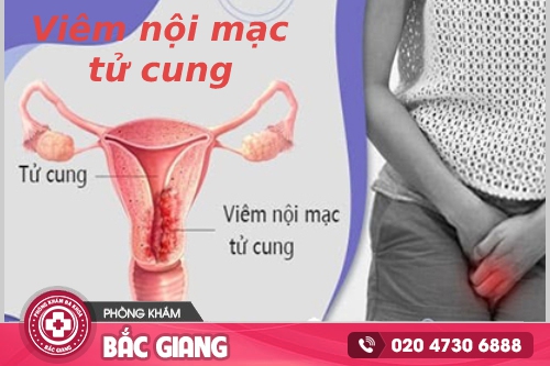 Nguyên nhân gây viêm nội mạc cổ tử cung là gì? Nguyên nhân gây viêm nội mạc cổ tử cung là gì?